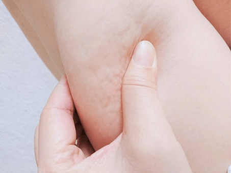 橘皮纹是怎么形成的？分享10个消除橘皮组织的方法